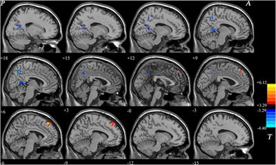 Dissociation Pattern in Default-Mode Network Homogeneity in Drug-Naive Bipolar Disorder